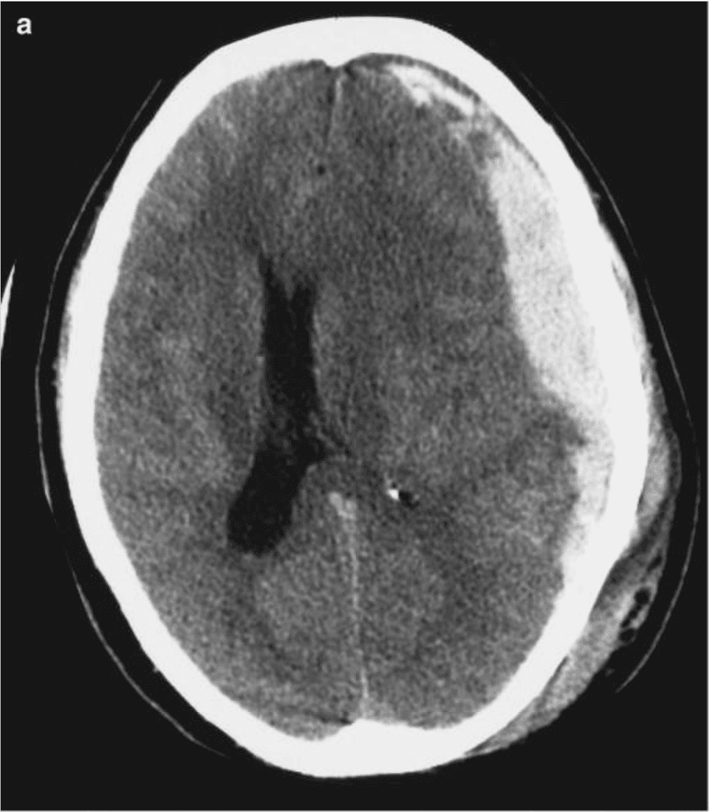 Non-contrast CT of the head showing an acute subdural haematoma — the kind of finding anticipated by an expanding anisocoria detected early.