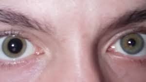 Clinical photograph of anisocoria: unequal pupil diameters between left and right eyes.