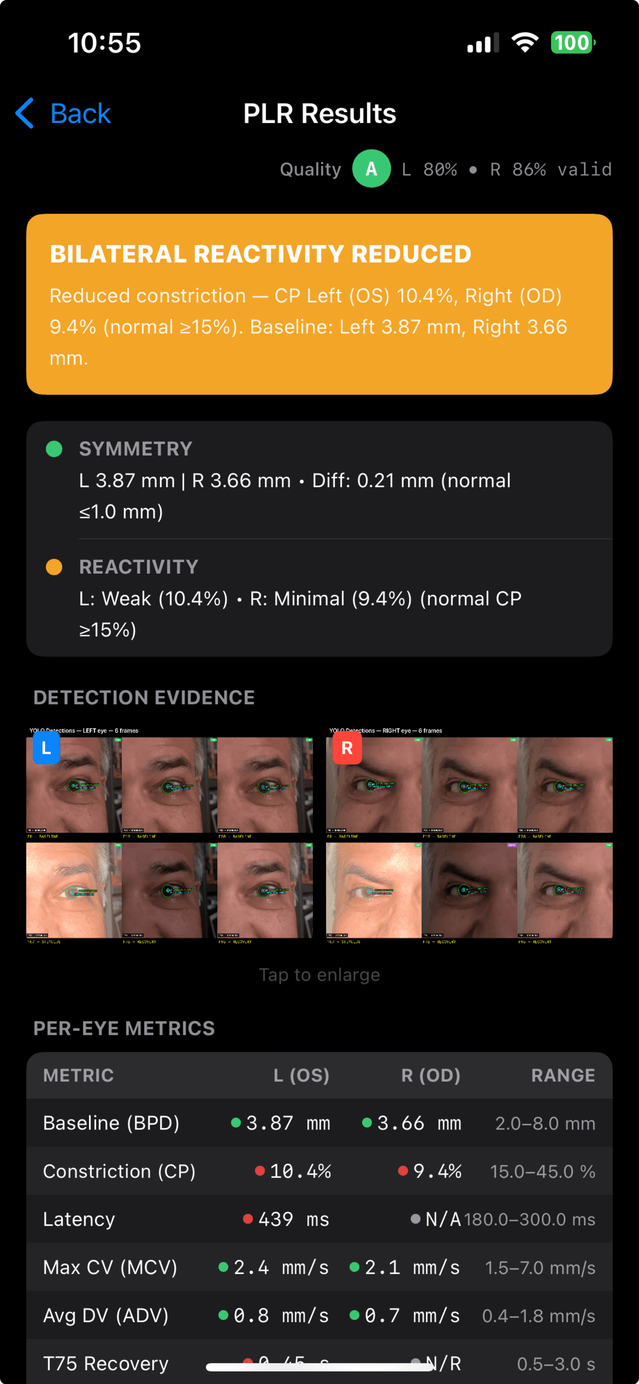 PupiLUX PLR Results screen showing bilateral reactivity status, detection evidence, and per-eye PLR metrics